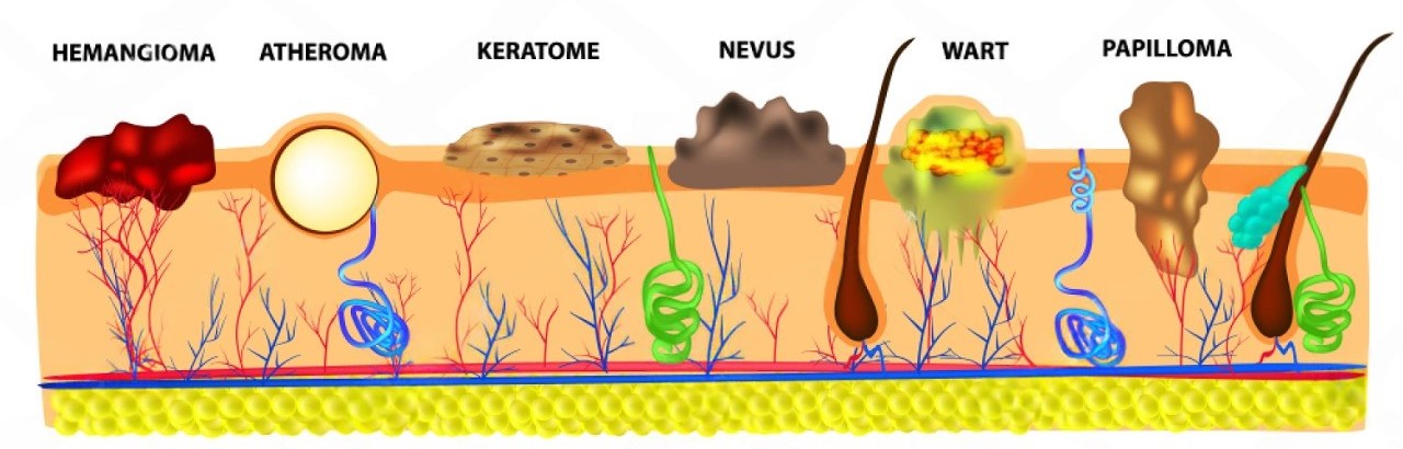 Types of skin growths: hemangioma, atheroma, keratoma, nevus, wart, papilloma