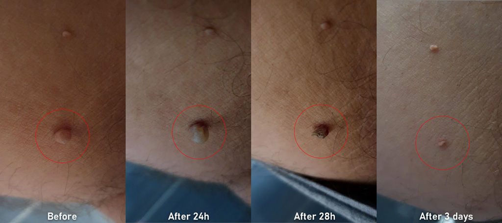 Laser removal of warts and papillomas in Maska